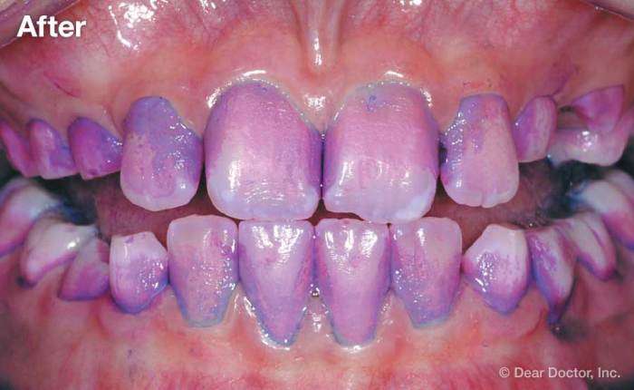 Purple food coloring on teeth